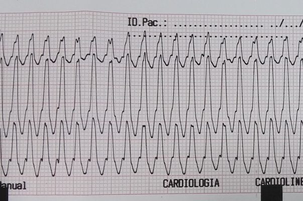taquicardia ventricular en electrocardiograma